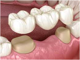 Replacing Missing Teeth